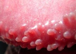 Gai bao quy đầu là gì? Có nguy hiểm không và cách điều trị