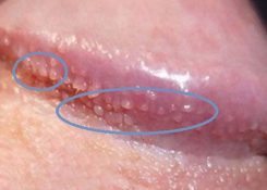 Hạt ngọc bao quy đầu là bệnh gì? Có nguy hiểm không