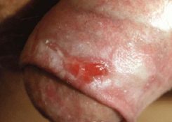 Viêm loét bao quy đầu nguy hiểm không? Nguyên nhân, cách điều trị
