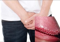 Mụn li ti đầu khấc là dấu hiệu của bệnh gì? Có nguy hiểm không?