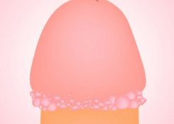 Nguyên nhân mụn ở rãnh bao quy đầu là gì? Cách điều trị hiệu quả