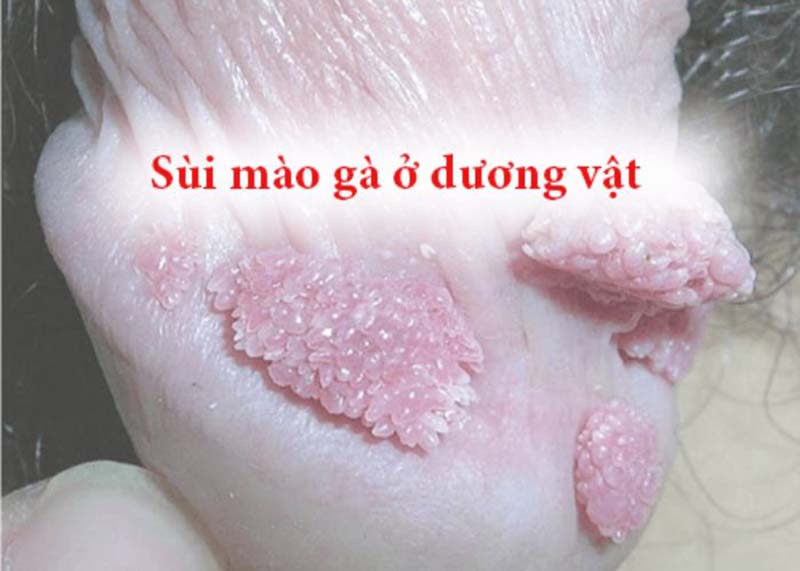 Nổi mụn thịt ở bao quy đầu là triệu chứng bệnh gì? 