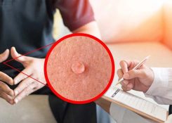 Nổi mụn thịt bao quy đầu | Nguyên nhân, cách điều trị hiệu quả