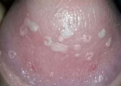 Nấm bao quy đầu: Nguyên nhân, dấu hiệu nhận biết, cách điều trị hiệu quả