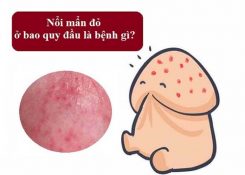 Nguyên nhân nổi mẩn đỏ ở bao quy đầu? Cảnh báo viêm nhiễm nam khoa