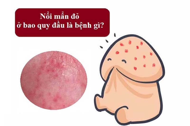 Nổi mẩn đỏ ở bao quy đầu là gì?