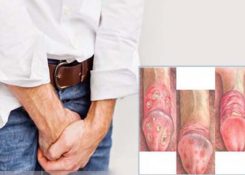 Nổi những nốt nhỏ ở bao quy đầu là bị sao? Có nguy hiểm không?