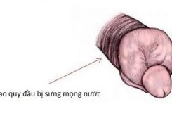 Phồng rộp bao quy đầu: Nguyên nhân cách điều trị hiệu quả