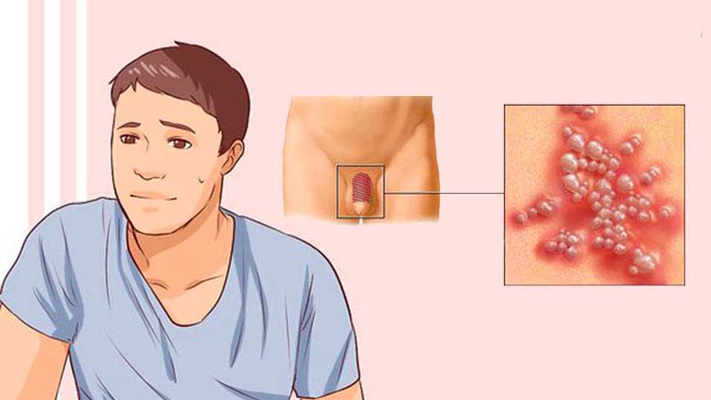 Herpes sinh dục