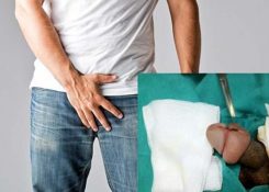Phù nề bao quy đầu có nguy hiểm không? Cách điều trị hiệu quả