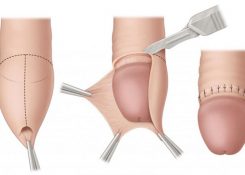 Phương pháp cắt bao quy đầu nào tốt nhất 2024