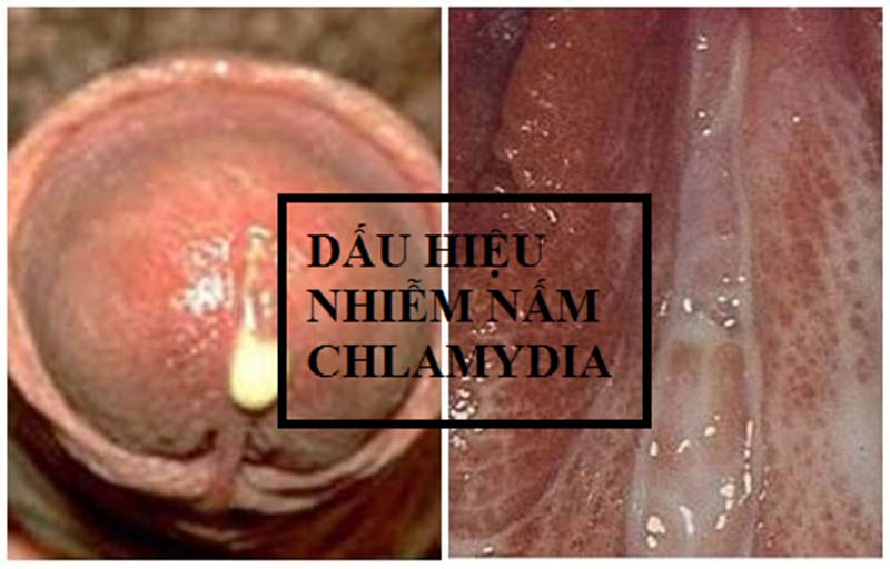 Bệnh CHLAMYDIA