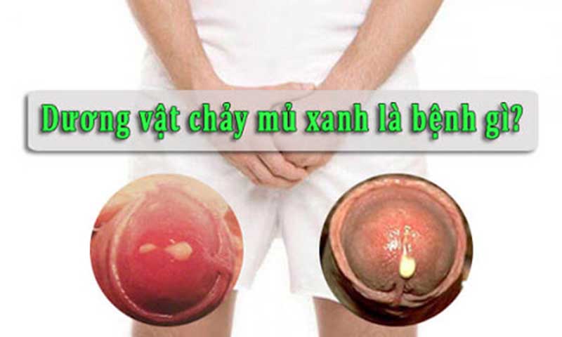 Chảy mủ ở bao quy đầu là bệnh gì?