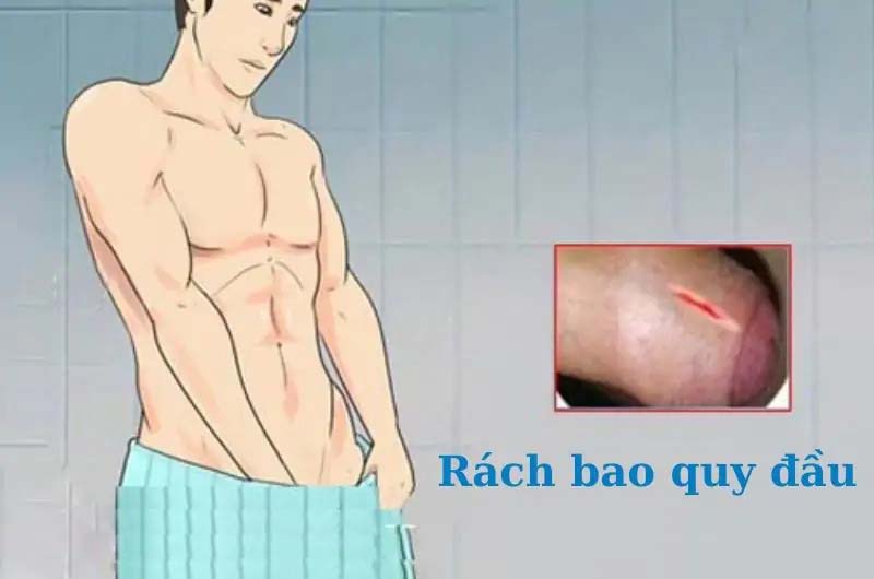 Rách bao quy đầu là gì? 