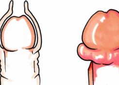 Bị sưng bao quy đầu nguyên nhân và cách điều trị hiệu quả