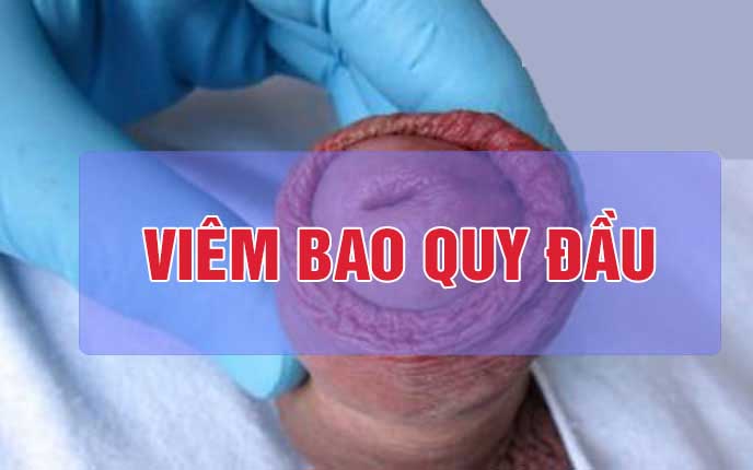 Viêm bao quy đầu là gì? 