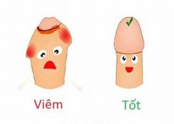 Bệnh viêm bao quy đầu có nguy hiểm không? Biến chứng thường gặp