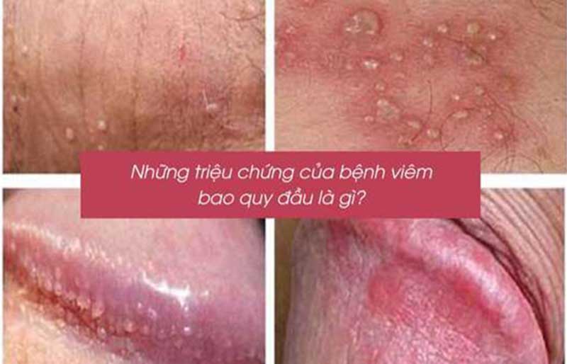 Các dấu hiệu nhận biết viêm bao quy đầu?