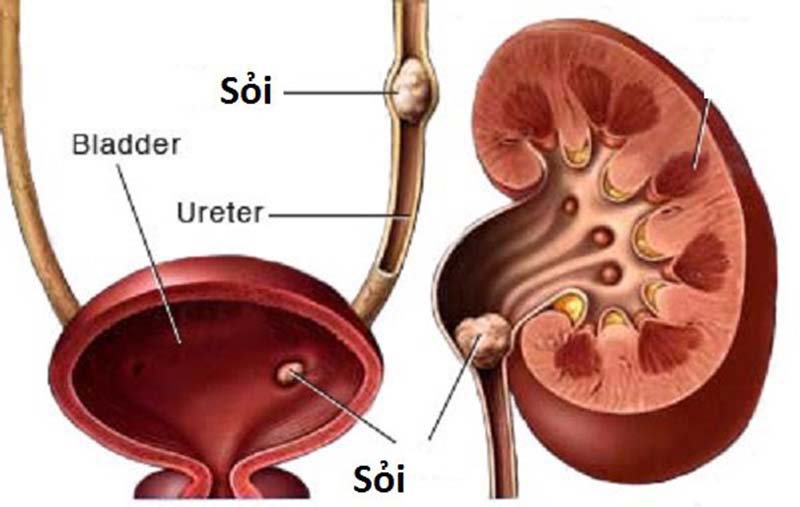 Sỏi hệ tiết niệu