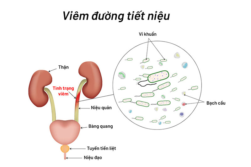 6 Bệnh đường tiết niệu thường gặp nhất