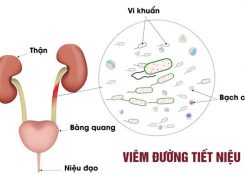 Bị viêm đường tiết niệu có quan hệ được không?