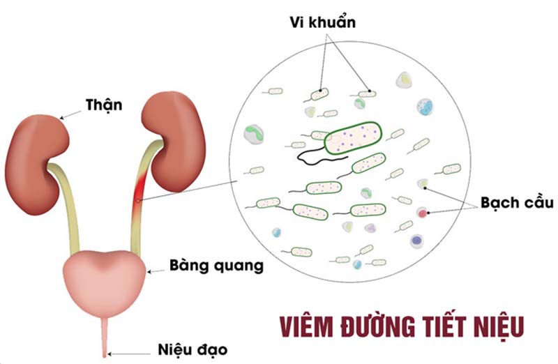 Viêm đường tiết niệu là gì? 