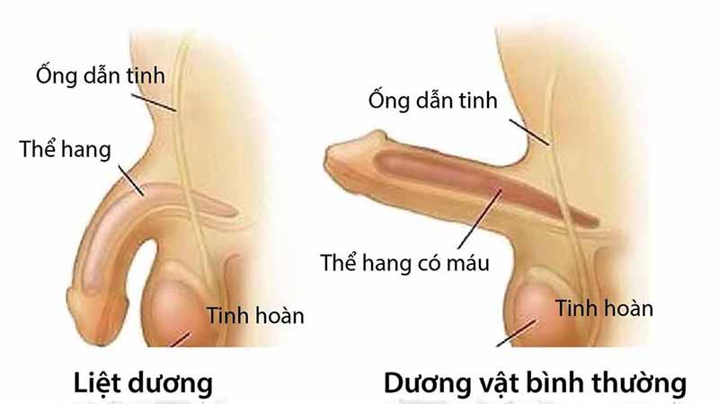 Bệnh rối loạn cương dương khi nào cần đi khám?