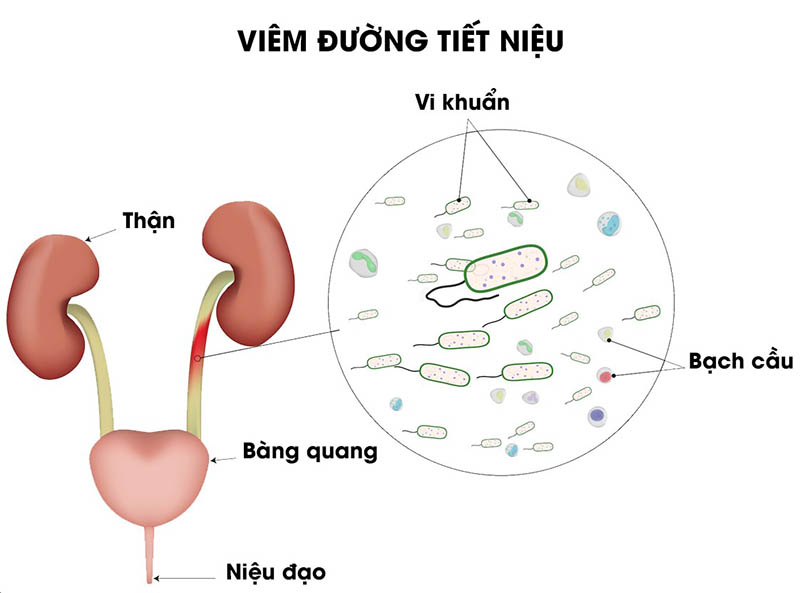 Nguyên nhân gây viêm đường tiết niệu