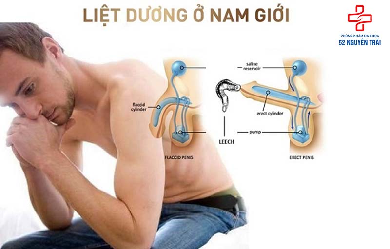 Nguyên nhây gây tình trạng liệt dương 