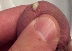 Lỗ sáo bị sưng đỏ biểu hiện bệnh gì? Cách điều trị