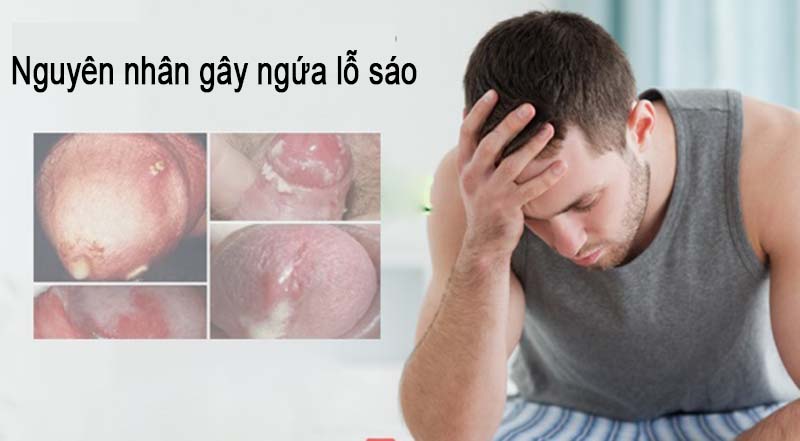 Nguyên nhân gây ngứa lỗ sáo