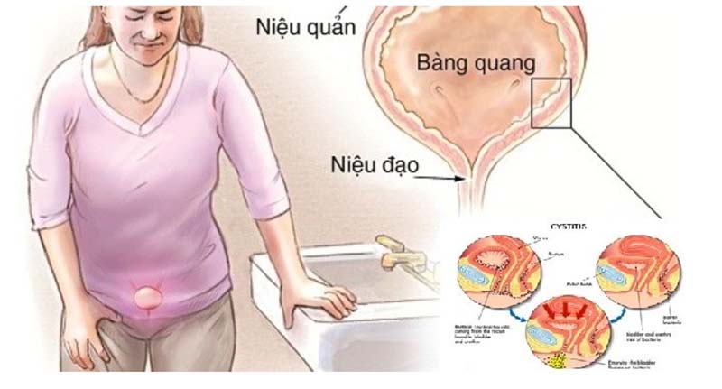 Nguyên nhân phổ biến gây viêm đường tiết niệu ở nam giới 