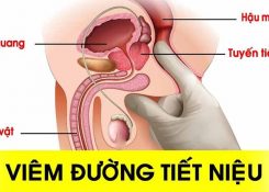 Bệnh viêm đường tiết niệu có dễ tái phát không?