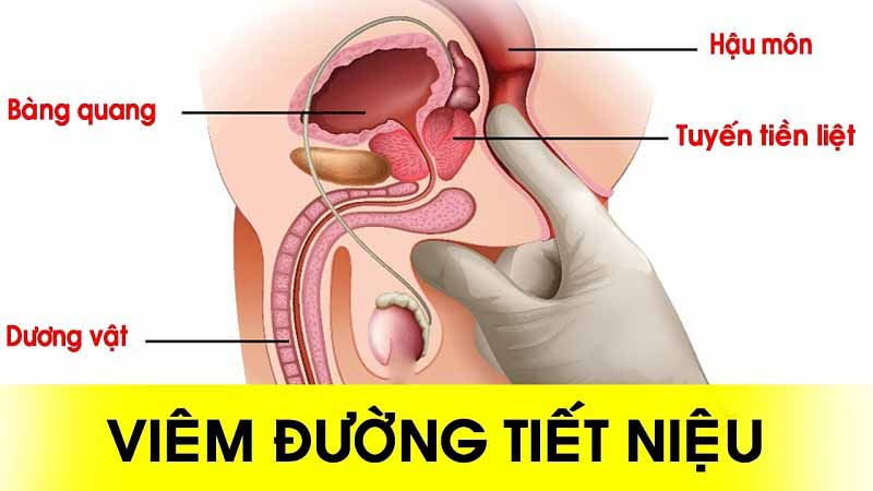 Viêm đường tiết niệu là bệnh gì? 