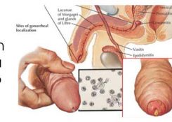 Viêm lỗ sáo chảy mủ là dấu hiệu bệnh gì? Cách điều trị hiệu quả
