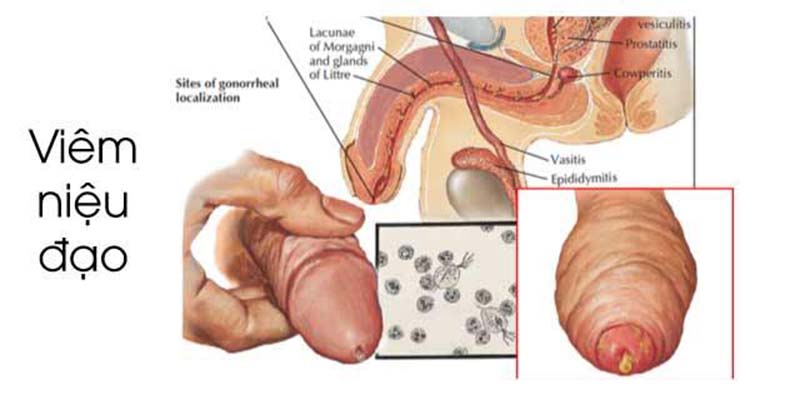 Nguyên nhân gây viêm lỗ sáo 