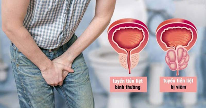 Viêm tuyến tiền liệt