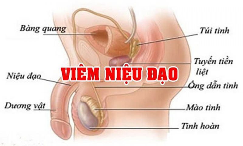 Tìm hiểu viêm niệu đạo là như thế nào?