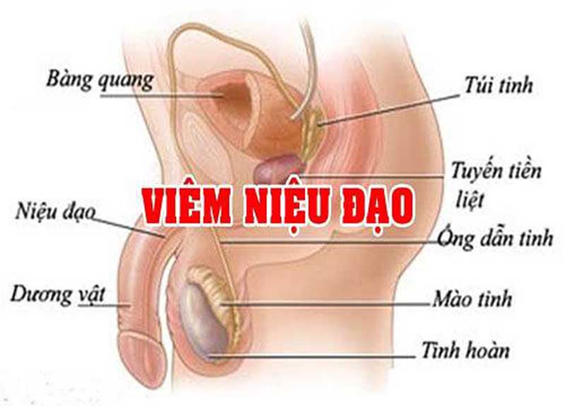 Viêm niệu đạo là gì?