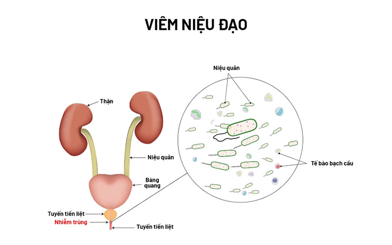 Nguyên nhân viêm niệu đạo ở nam giới?