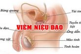 Viêm niệu đạo: Nguyên nhân, triệu chứng, cách điều trị hiệu quả