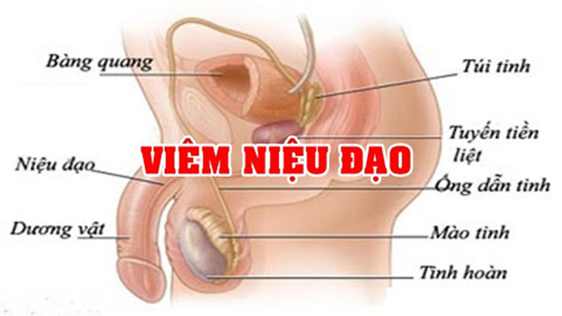 Viêm niệu đạo nam giới là gì?