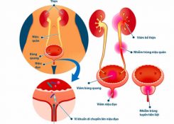 Phân biệt viêm niệu đạo và viêm đường tiết niệu