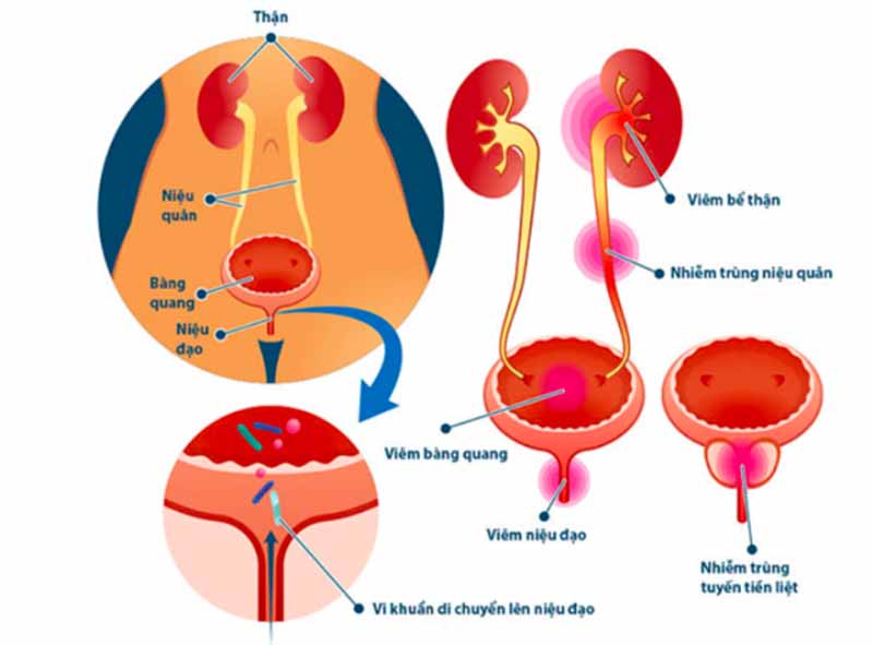 Tìm hiểu viêm niệu đạo và viêm đường tiết niệu