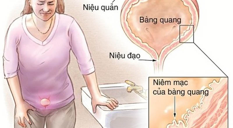 Nguyên nhân gây tình trạng nhiễm trùng đường tiểu