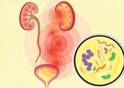 5 Dấu hiệu sớm nhận biết nhiễm trùng đường tiểu và cách điều trị