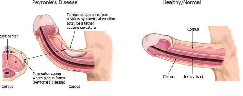 Dương vật bị cong ( Bệnh Peyroie)