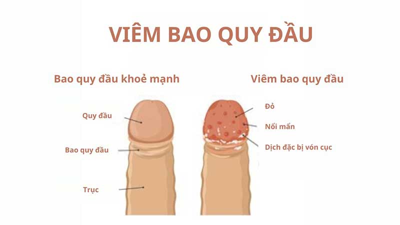 Bị viêm rát ngứa đầu khấc cảnh báo bệnh gì? 