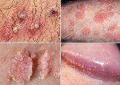 Dương vật nổi hạt nhỏ có nguy hiểm không? Cách điều trị hiệu quả