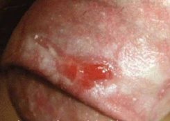 Khi bị nấm ở dương vật có bị ngứa không? Cách điều trị hiệu quả